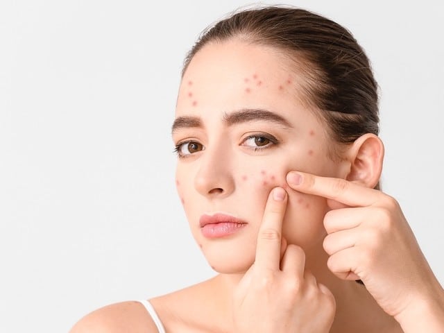 woman with acne problem squishing pimples